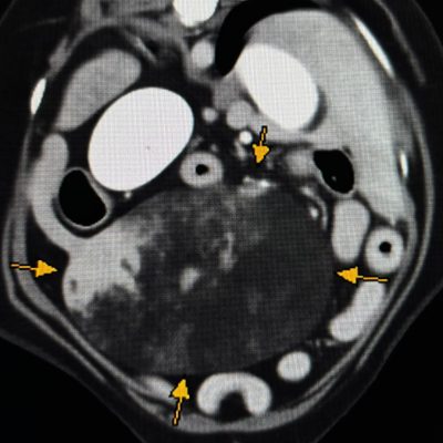 ct3